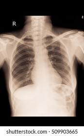 Normal Chest Xray In Adult