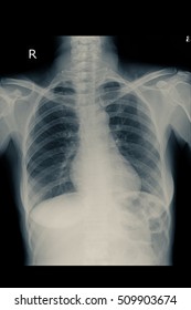 Normal Chest Xray In Adult