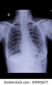 Normal Chest Xray In Adult