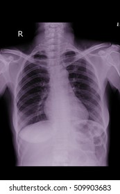 Normal Chest Xray In Adult