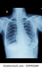 Normal Chest Xray In Adult