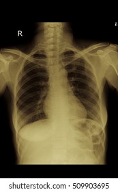 Normal Chest Xray In Adult