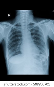 Normal Chest Xray In Adult