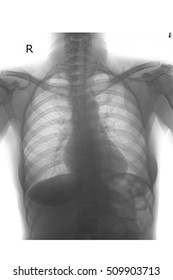 Normal Chest Xray In Adult