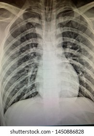 Normal chest x-ray with endotracheal tube in good position