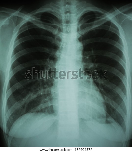 Normal Chest Xray Woman Stock Photo (Edit Now) 182904572