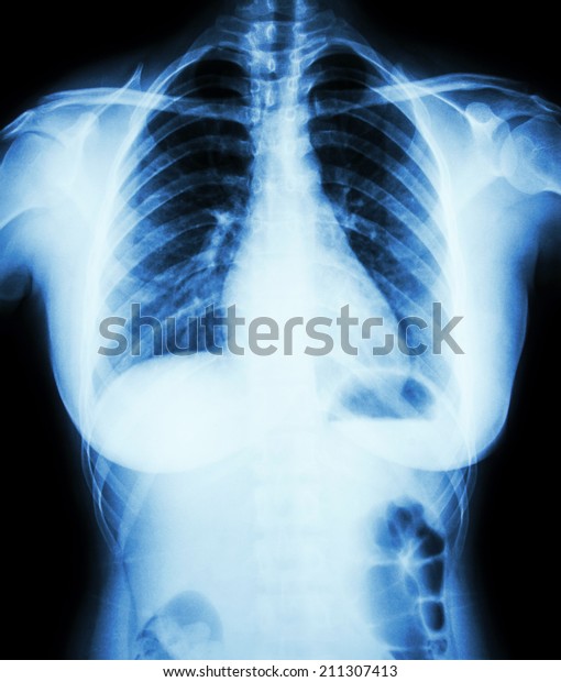 Normal Chest Xray Woman Stock Photo (Edit Now) 211307413