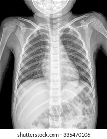 Normal Chest X-ray Of Young Boy.