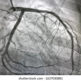 Normal Coronary Angiogram Of Left Coronary Artery During Cardiac Catheterization.