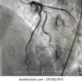 Normal Coronary Angiogram Of Left Coronary Artery During Cardiac Catheterization.