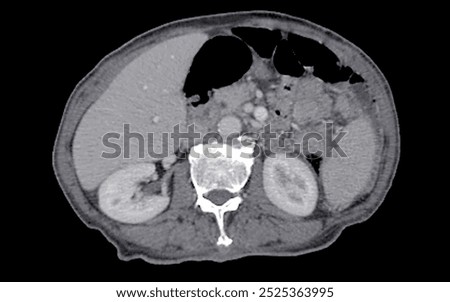 A normal CT scan of the upper abdomen, showing clear and healthy cross-sectional anatomy of the liver, spleen, stomach, and spine, with no abnormalities detected