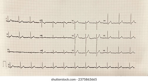 normal ECG. Echocardiography of a normal individual. used in medical practice to determine heart diseases.