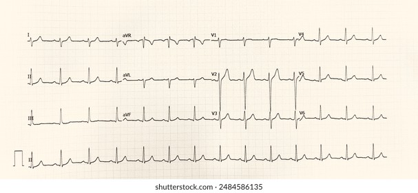 It's a normal ECG with rightward deviation. usually found in individual with musculoskeletal pain of left chest and even in a normal healthy person with no symptoms at all.