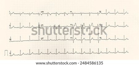 It's a normal ECG with rightward deviation. usually found in individual with musculoskeletal pain of left chest and even in a normal healthy person with no symptoms at all.