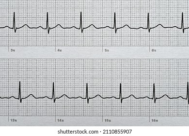 Normal Electrocardiogram With Sinus Rhythm 