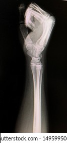 x ray wrist lateral view