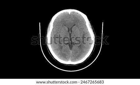 normal head ct scan brain window