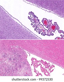 Normal Healthy Brain (top) And Brain With Metastatic Lymphoma (bottom) With Tumor Cells Invading And Replacing Healthy Brain Tissue. Choroid Plexus And Ventricle Are Also Shown.