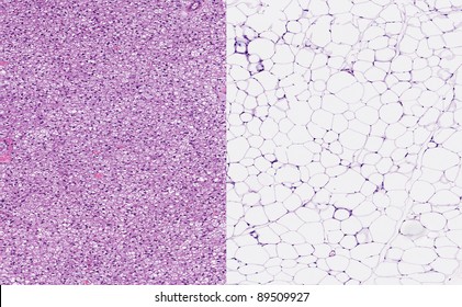 Normal Healthy Brown Fat (left Image) And Normal Healthy White Fat. Brown Adipose Tissue Or Hibernating Gland With Small Fat Vacuoles (left) And White Adipose Tissue (right) With Large Fat Vacuoles