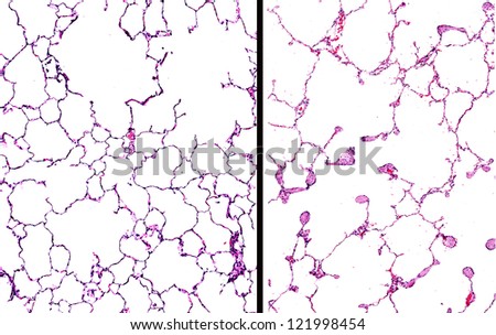 Smokers Lung Pictures Smokers Lungs Vs Healthy Lungs