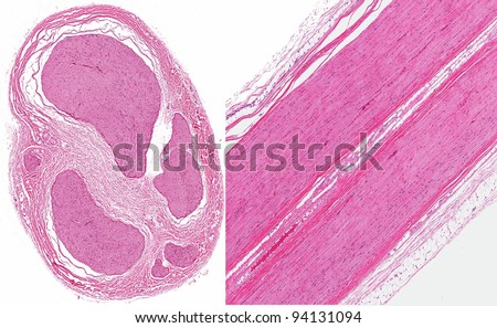 Normal healthy sciatic nerve in cross section (left) and longitudinal (sagittal section) on the right.