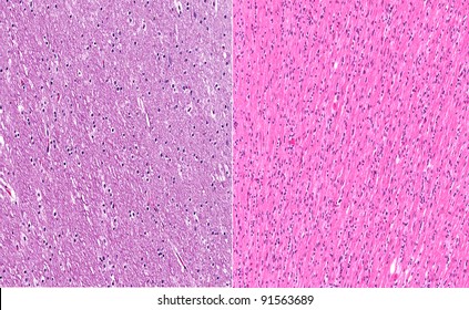 Normal Healthy White Matter Of Brain (left) In Contrast To White Matter Of Brain From A Case Of Gliomatosis Cerebri (right)