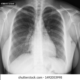 Normal High Resolution Chest Xray Healthy Stock Photo 1492053998 ...