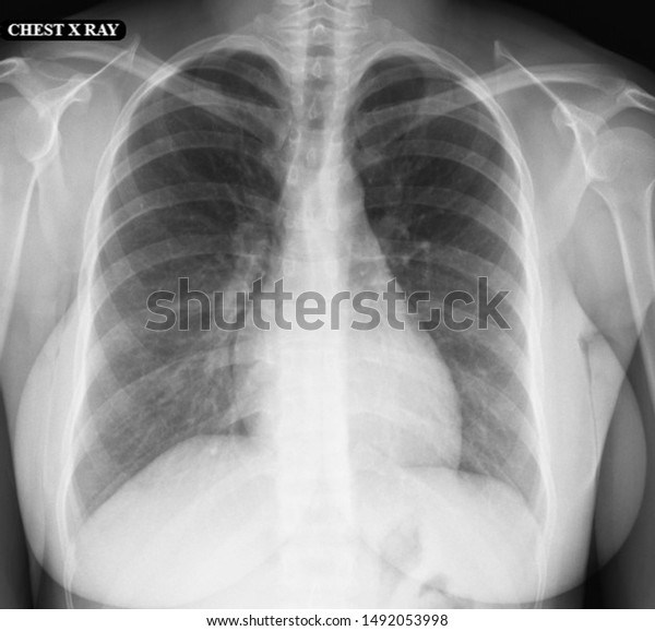 Normal High Resolution Chest Xray Healthy Stock Photo (Edit Now) 1492053998