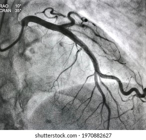Normal Left Coronary Artery Angiogram.