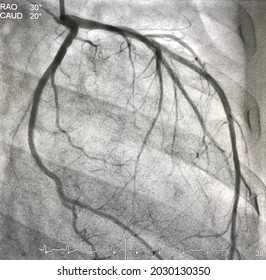 Normal Left Coronary Artery Angiography.
