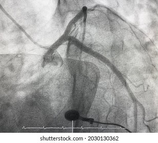 Normal Left Coronary Artery Angiography.