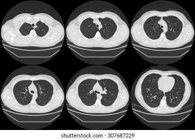 Normal Lungs On Computed Tomography 