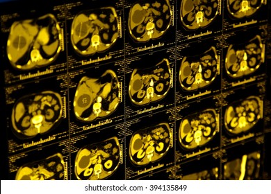 Normal Lungs On Computed Tomography