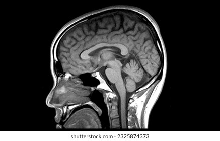 The normal Magnetic resonance image (MRI, sagittal view) of the brain in a healthy 30 years old male.