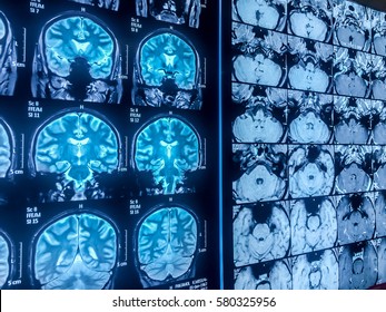 Normal MRI Brain