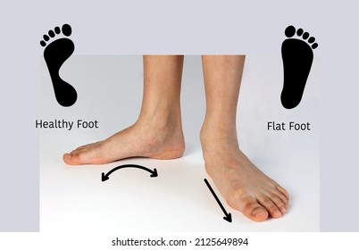 Normal Neutral Healthy Foot Compare With  Flat Foot Or Fallen Arch Problem With Foot Print To Show How Entire Sole Of The Foot To Touch The Floor When Stand Up.