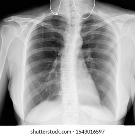 Normal Radiography Chest Lungspulmonology Medical Diagnostics Stock ...