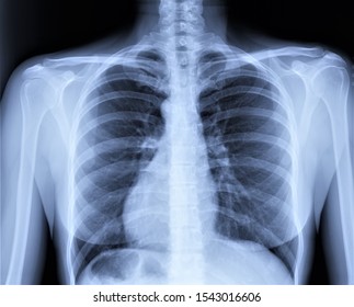 Normal Radiography Of The Chest And Lungs,pulmonology, Medical Diagnostics