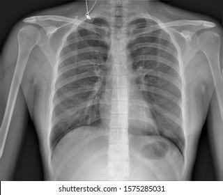 Normal Radiography Childs Chest Direct Projection Stock Photo 