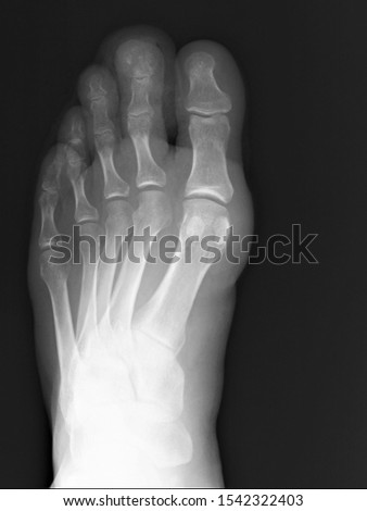 normal radiography of the foot, medical diagnostics, traumatology and orthopedics