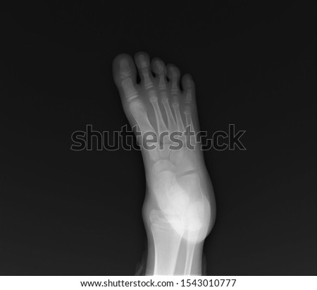normal radiography of the foot, medical diagnostics, traumatology and orthopedics