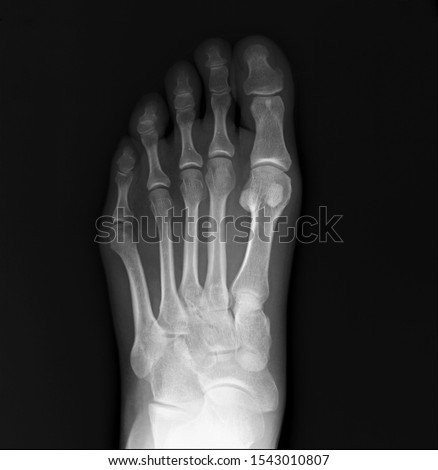 normal radiography of the foot, medical diagnostics, traumatology and orthopedics