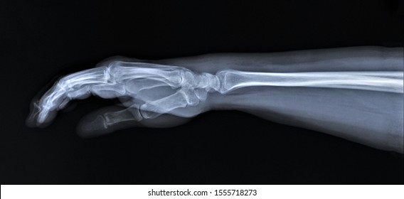 normal radiography of hand and wrist bones, traumatology and orthopedics, traumatology - Shutterstock ID 1555718273