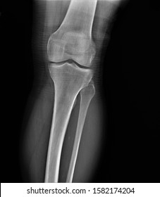 Normal Xray Knee Joint Stock Photo 1701878086 | Shutterstock