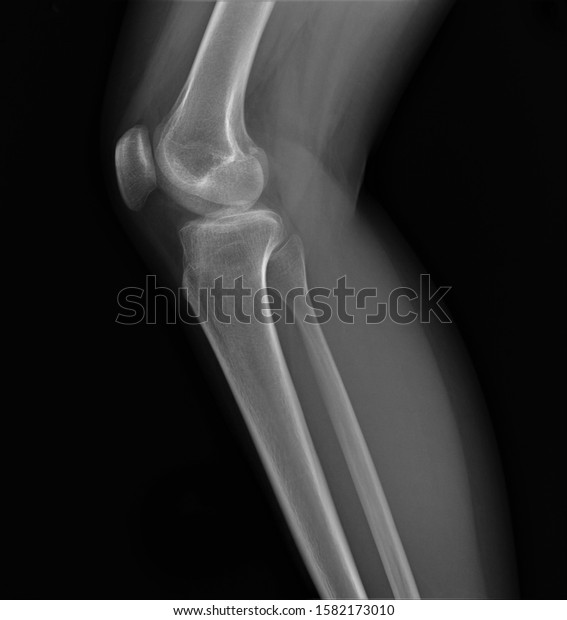 Normal Radiography Knee Joint Lateral Projection Stock Photo 1582173010 ...