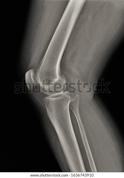 Normal Radiography Knee Joint Lateral Projection Stock Photo 1636743910 ...