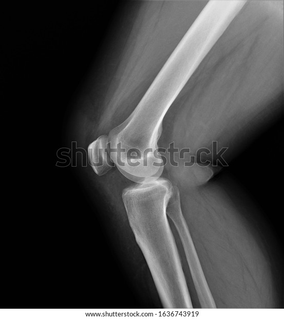 Normal Radiography Knee Joint Lateral Projection Stock Photo 1636743919 