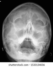 Normal Radiography Paranasal Sinuses Facial Skull Stock Photo ...