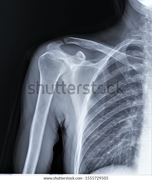 Normal Radiography Shoulder Joint Direct Projection Stock Photo ...