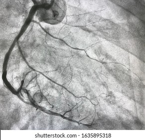 Normal right coronary angiogram at cath lab.